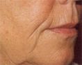 Dermal fillers - Photo before - NZOZ KRIOCENTRUM