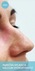 Radiesse (Calcium hydroxylapatit) - Fotka pred - Chirkoz Medical Clinic