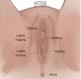 Labiaplasty (Labia Reduction) - Did you know that many women live with pain or reduced sexual pleasure and embarrassment due to a loosening of their vagina or an enlarged or misshapen labia, most often due to aging or childbirth.
While a growing number of women are motivated to improve their sex lives and feel better about themselves, many don’t know where to turn or may feel too embarrassed to discuss this issue with friends, family or even a health care provider. Our physicians want you to know that your health and well-being is their top priority. They have the experience, sensitivity and knowledge to help you.
