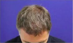 Haartransplantation - Vorher Foto - Prohaarklinik