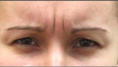 Botulinum toxin - Wrinkle Removal - Photo before - Dr Irene Gladstein MD