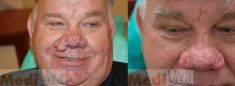 Rhinoplasty (Nose Job) - Photo before - lek. med. Jacek Ściborowicz - MediVita