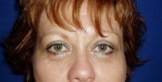Eyelid surgery (Blepharoplasty) - Photo before - Klinika Laser Esthetic