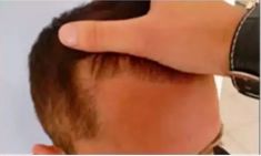 Haartransplantation - Vorher Foto - Prohaarklinik