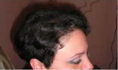 Haartransplantation - Vorher Foto - Prohaarklinik
