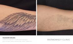 Tattoo removal - Photo before - Bieńkowscy Clinic®
