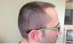 Haartransplantation - Vorher Foto - Prohaarklinik