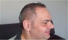 Haartransplantation - Vorher Foto - Prohaarklinik