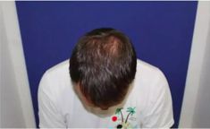Haartransplantation - Vorher Foto - Prohaarklinik