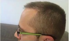Haartransplantation - Vorher Foto - Prohaarklinik