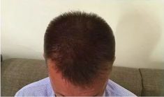 Haartransplantation - Vorher Foto - Prohaarklinik