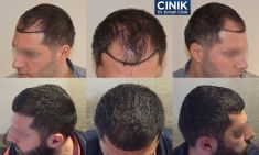 عملية نقل الشعر - الصورة قبل - Dr. Emrah Cinik