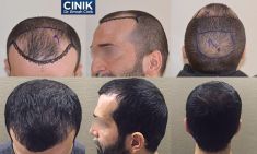 عملية نقل الشعر - الصورة قبل - Dr. Emrah Cinik