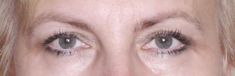 Eyelid surgery (Blepharoplasty) - Photo before - Klinika Laser Esthetic