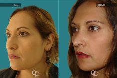 Cirugía de la nariz (Rinoplastia) - Paciente con nariz grande y Rinocifosis después de la rinoplastia vemos una nariz natural armónica al rostro mejorando el perfil Femenino