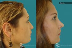 Cirugía de la nariz (Rinoplastia) - Paciente con nariz grande y Rinocifosis después de la rinoplastia vemos una nariz natural armónica al rostro mejorando el perfil Femenino