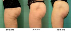 Alternatywa liposukcji – nieinwazyjne usuwanie tłuszczu i cellulitu - Zdjęcie przed - Revival Clinic - Klinika Medycyny Estetycznej i Laseroterapii
