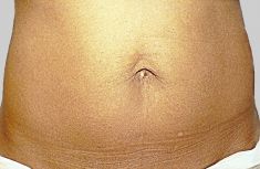 Exilis - Zdjęcie przed - Revival Clinic - Klinika Medycyny Estetycznej i Laseroterapii