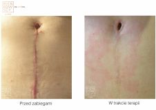Laserowe usuwanie blizn - Zdjęcie przed - Bieńkowscy Clinic®
