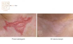 Laserowe usuwanie blizn - Zdjęcie przed - Bieńkowscy Clinic®