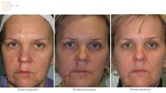Laserowe usuwanie blizn - Zdjęcie przed - Bieńkowscy Clinic®