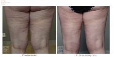 Liposukcja ultradźwiękowa (VASER Lipo®, LipoSelection®) - Zdjęcie przed - Bieńkowscy Clinic®