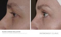 Nieinwazyjny lifting - Zdjęcie przed - Bieńkowscy Clinic®