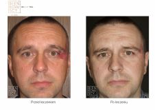 Leczenie naczyniaków (haemangioma) - Zdjęcie przed - Bieńkowscy Clinic®