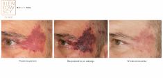 Leczenie naczyniaków (haemangioma) - Zdjęcie przed - Bieńkowscy Clinic®