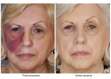 - Photo before - Bieńkowscy Clinic®