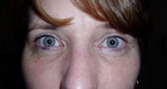 Eyelid surgery (Blepharoplasty) - Photo before - Klinika Laser Esthetic