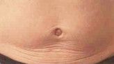 Radiofrequency Rejuvenation (Aluma, accent, TriPollar, Spa RF device, Re-Age) - Photo before - Klinika Laser Esthetic