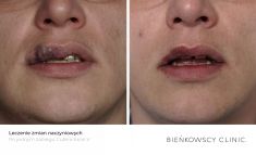 Leczenie naczyniaków (haemangioma) - Zdjęcie przed - Bieńkowscy Clinic®