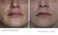 Leczenie naczyniaków (haemangioma) - Zdjęcie przed - Bieńkowscy Clinic®