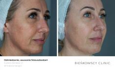 Fotoodmładzanie / odmładzanie skóry - Zdjęcie przed - Bieńkowscy Clinic®