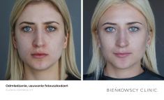 Entfernung erweiterter Äderchen per Laser - Vorher Foto - Bieńkowscy Clinic®