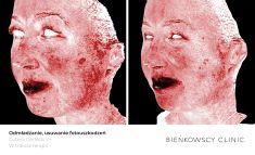 Laserowe usuwanie rozszerzonych naczynek - Zdjęcie przed - Bieńkowscy Clinic®