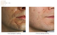 Fat (lipofiling) - Photo before - Dr n. med. Marcin Bieńkowski
