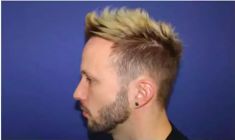 Haartransplantation - Vorher Foto - Prohaarklinik