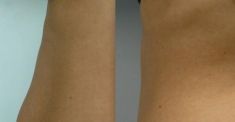 Abdominoplasty (Tummy Tucks) - Photo before - Dr. med. Jozefina Skulavik