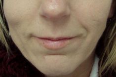 Lipofilling, Lipografting, Lipotransfer (přenos a aplikace vlastního tuku) - fotka před - MUDr. Evžen Trupar Ph.D.