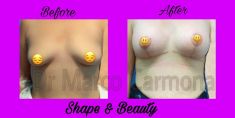 Liposucción - Foto Antes de - Dr. Marco Antonio Carmona M.D.