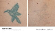 Laserowe usuwanie tatuażu i pigmentów - Zdjęcie przed - Dr Ilona Wnuk-Bieńkowska