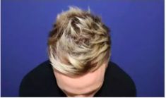 Haartransplantation - Vorher Foto - Prohaarklinik