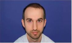 Haartransplantation - Vorher Foto - Prohaarklinik