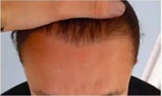 Haartransplantation - Vorher Foto - Prohaarklinik