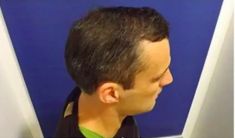 Haartransplantation - Vorher Foto - Prohaarklinik