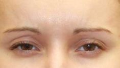Botulinum toxin - Wrinkle Removal - Photo before - Dr Irene Gladstein MD