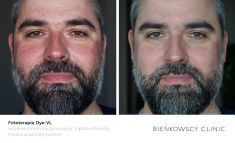 Spider veins laser removal (redness, birh marks) - Photo before - Bieńkowscy Clinic®