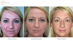 Laser Scar Treatment - Photo before - Dr n. med. Marcin Bieńkowski
